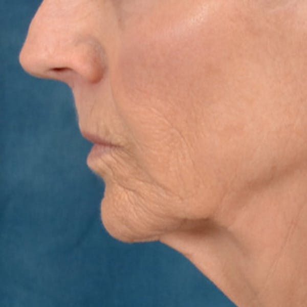Lip Lift Before & After Gallery - Patient 114809 - Image 9