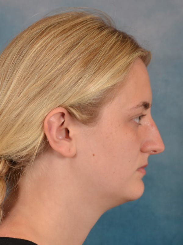 Rhinoplasty Before & After Gallery - Patient 544468 - Image 9