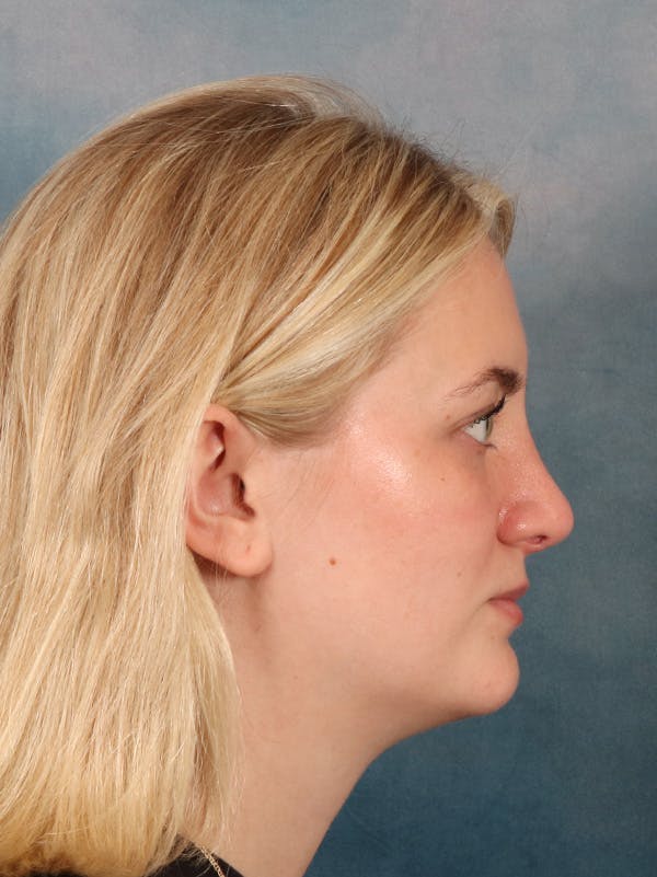 Rhinoplasty Before & After Gallery - Patient 544468 - Image 10
