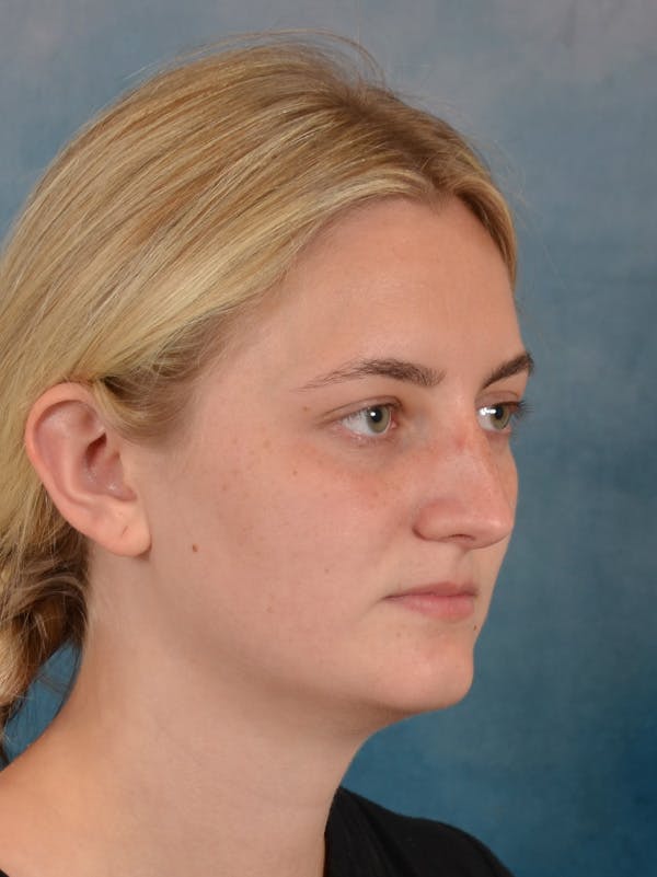 Rhinoplasty Before & After Gallery - Patient 544468 - Image 7