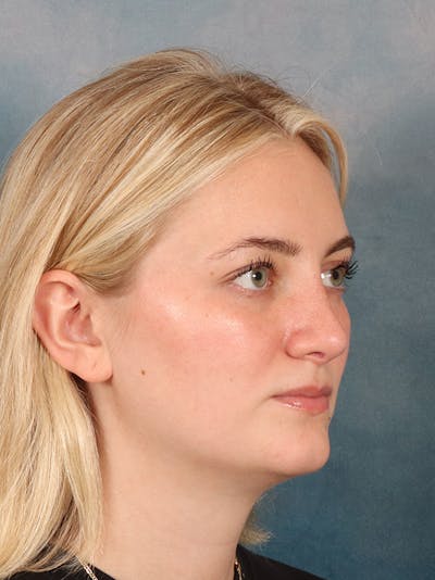 Rhinoplasty Before & After Gallery - Patient 544468 - Image 8