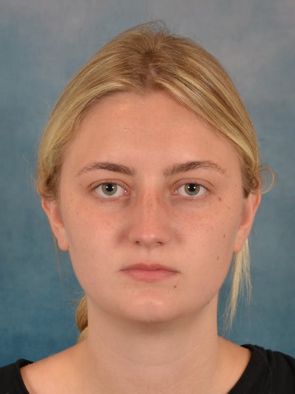 Rhinoplasty Before & After Gallery - Patient 544468 - Image 5