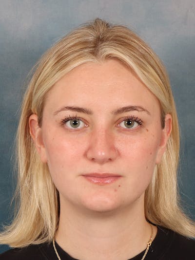 Rhinoplasty Before & After Gallery - Patient 544468 - Image 6