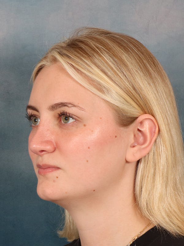 Rhinoplasty Before & After Gallery - Patient 544468 - Image 4