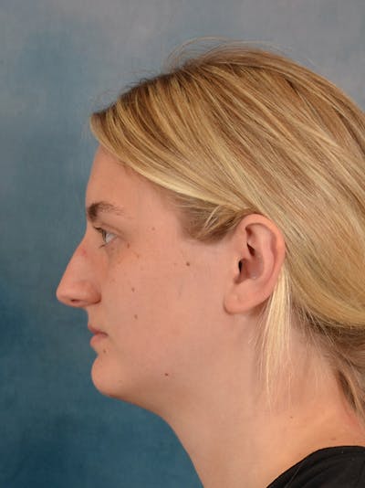 Rhinoplasty Before & After Gallery - Patient 544468 - Image 1
