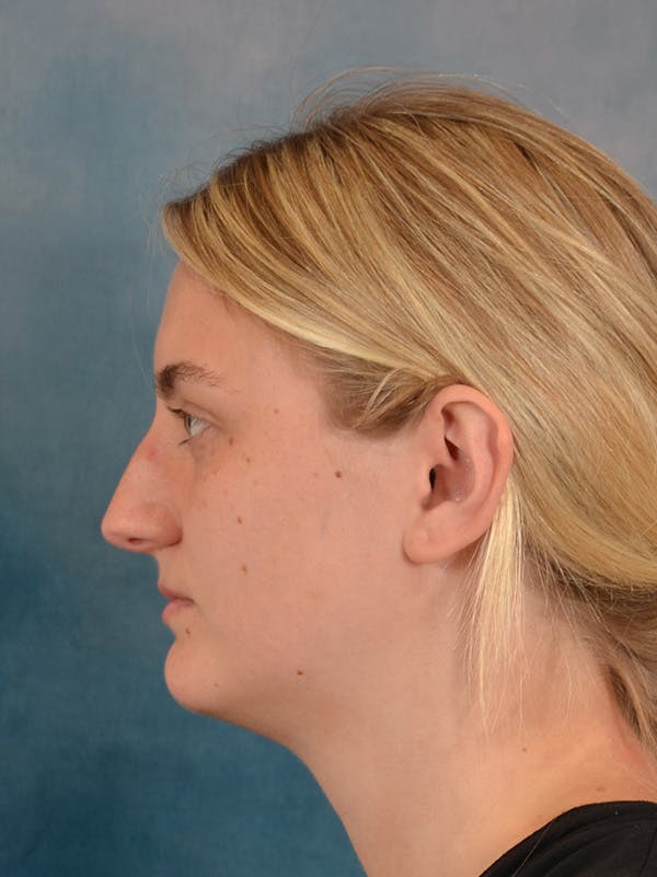 Rhinoplasty Before & After Gallery - Patient 544468 - Image 1