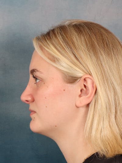 Rhinoplasty Before & After Gallery - Patient 544468 - Image 2