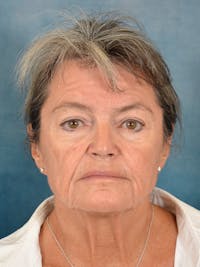 Brow Lift Before & After Gallery - Patient 139396 - Image 1