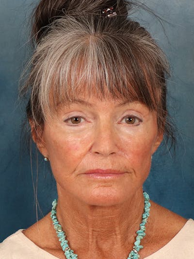 Brow Lift Before & After Gallery - Patient 139396 - Image 2