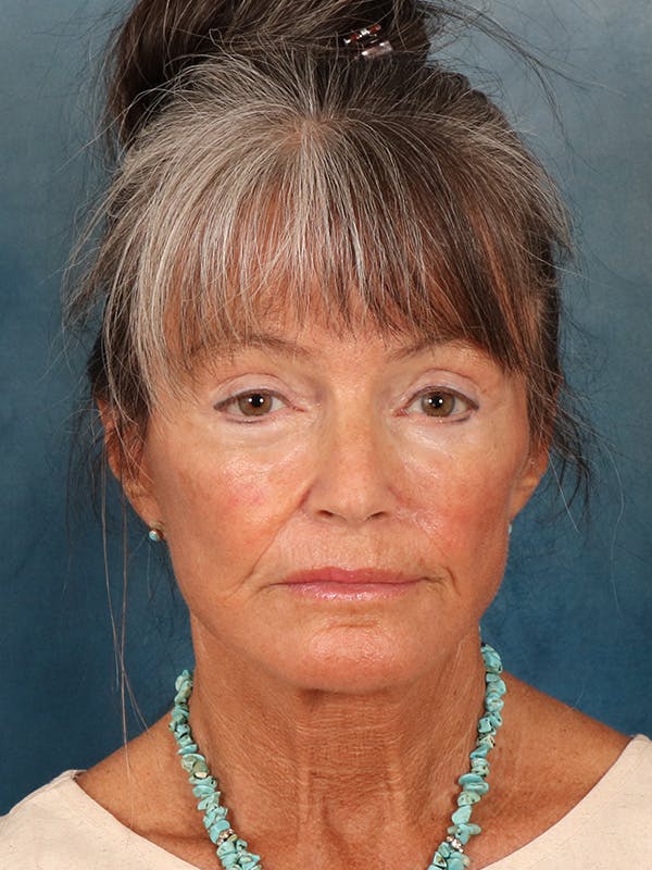 Brow Lift Before & After Gallery - Patient 139396 - Image 2