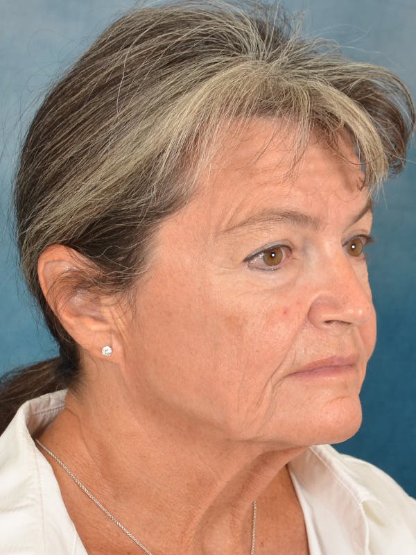 Brow Lift Before & After Gallery - Patient 139396 - Image 7