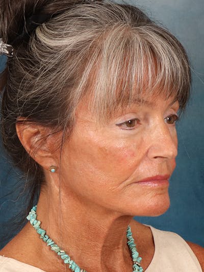 Brow Lift Before & After Gallery - Patient 139396 - Image 8