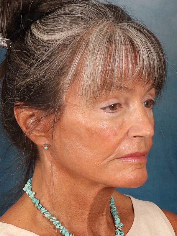 Brow Lift Before & After Gallery - Patient 139396 - Image 8