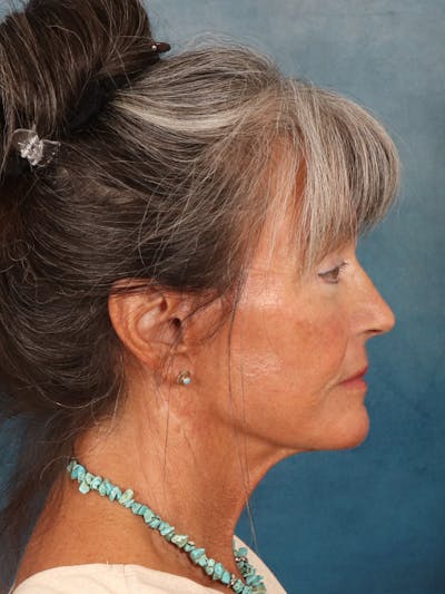 Brow Lift Before & After Gallery - Patient 139396 - Image 10