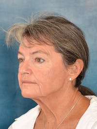 Deep Plane Facelift Before & After Gallery - Patient 148969 - Image 1