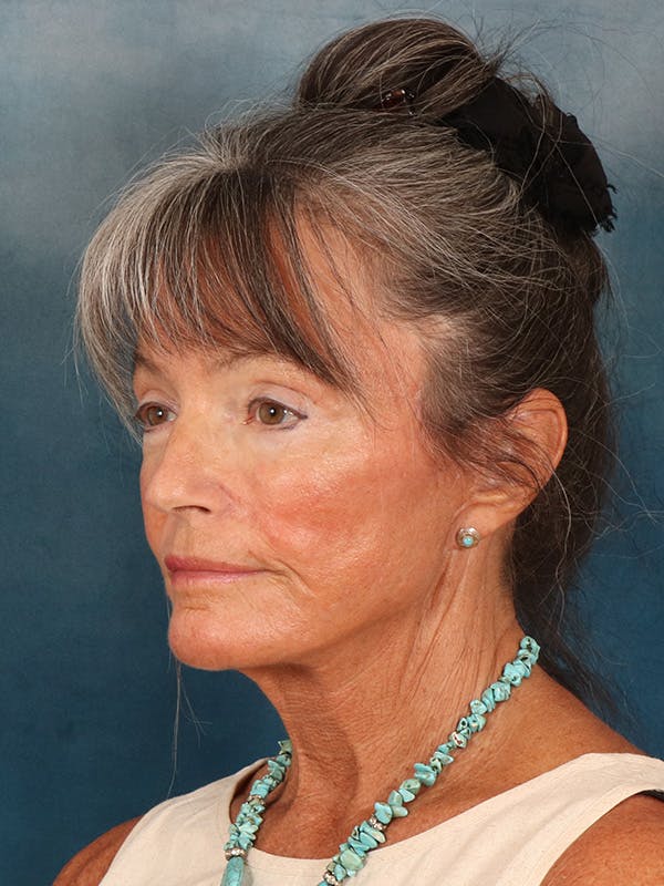 Brow Lift Before & After Gallery - Patient 139396 - Image 4