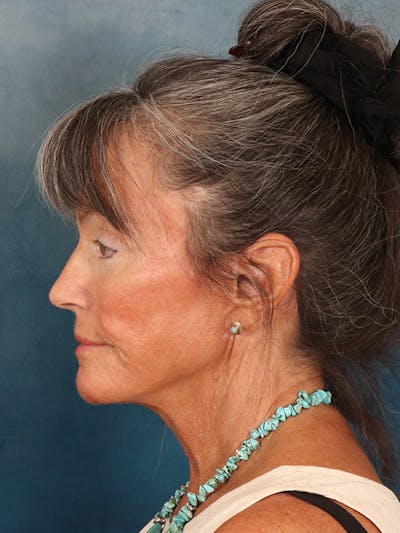 Brow Lift Before & After Gallery - Patient 139396 - Image 6