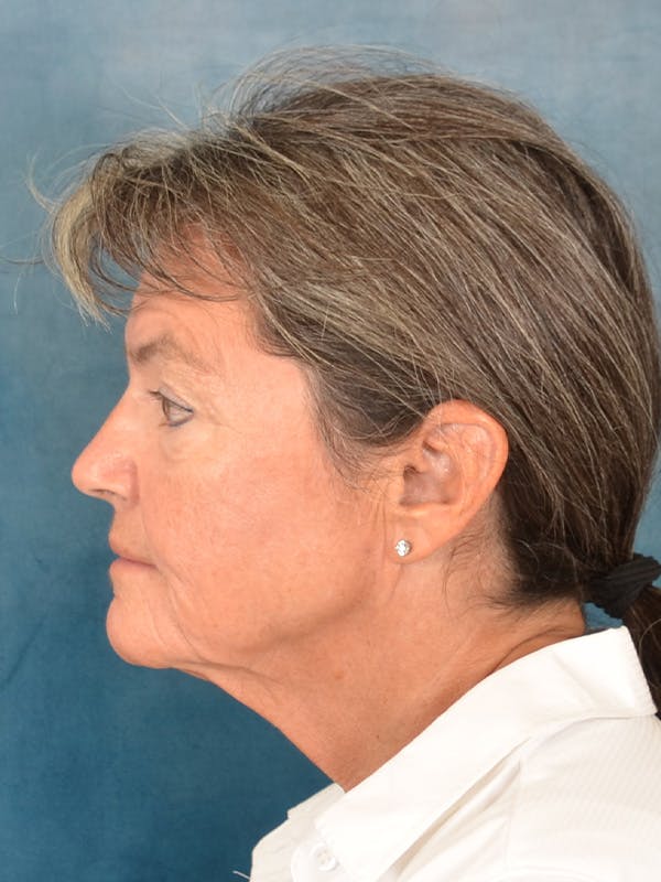 Brow Lift Before & After Gallery - Patient 139396 - Image 5