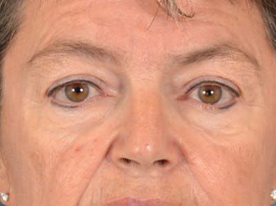 Eyelid Lift Before & After Gallery - Patient 676091 - Image 1