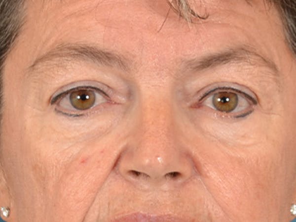 Eyelid Lift Before & After Gallery - Patient 676091 - Image 1