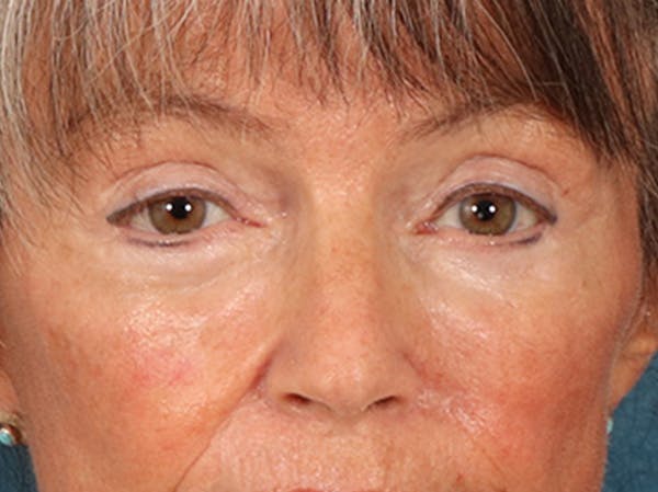Eyelid Lift Before & After Gallery - Patient 676091 - Image 2