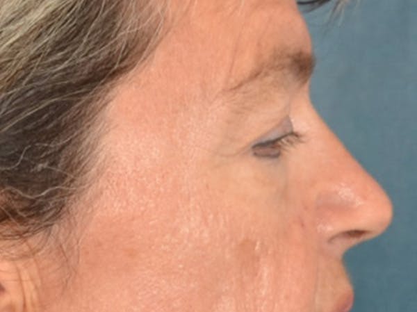 Eyelid Lift Before & After Gallery - Patient 676091 - Image 5
