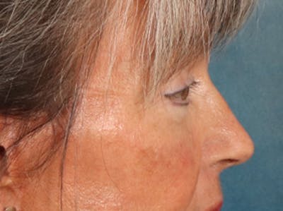 Eyelid Lift Before & After Gallery - Patient 676091 - Image 6
