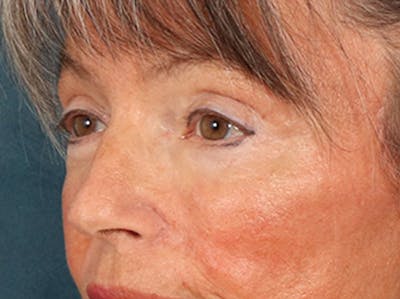 Eyelid Lift Before & After Gallery - Patient 676091 - Image 8