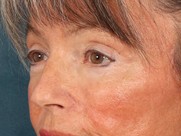 Eyelid Lift Before & After Gallery - Patient 676091 - Image 8