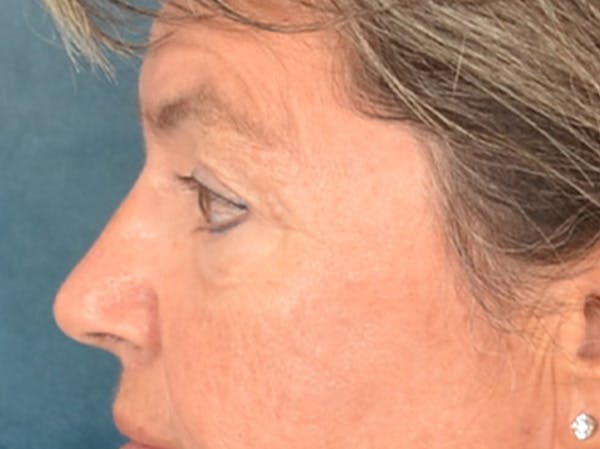 Eyelid Lift Before & After Gallery - Patient 676091 - Image 9