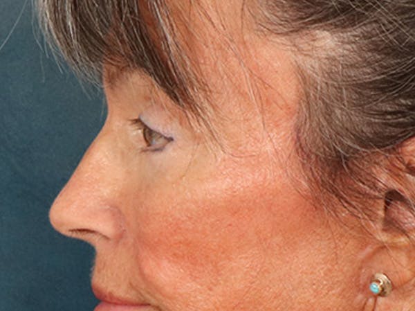 Eyelid Lift Before & After Gallery - Patient 676091 - Image 10