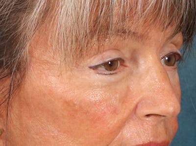 Eyelid Lift Before & After Gallery - Patient 676091 - Image 4