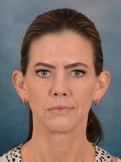 Fat Transfer Before & After Gallery - Patient 111639 - Image 1