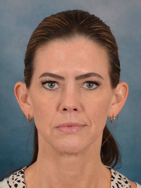 Laser Skin Resurfacing Before & After Gallery - Patient 287437 - Image 1