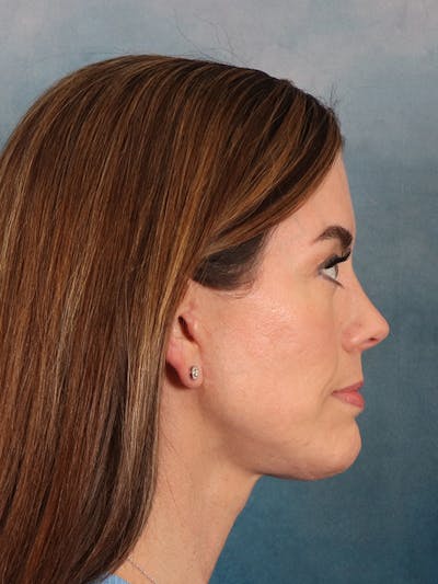 Laser Skin Resurfacing Before & After Gallery - Patient 287437 - Image 8
