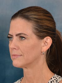 Deep Plane Facelift Before & After Gallery - Patient 320524 - Image 1