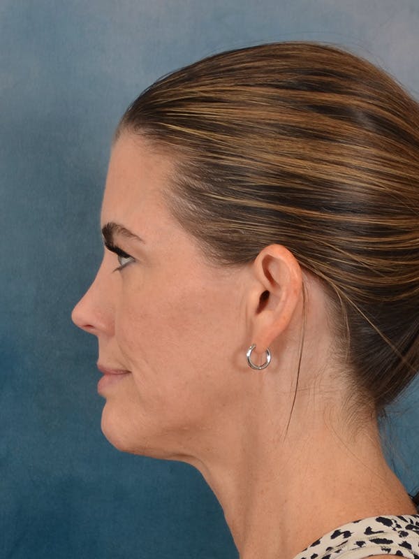 Laser Skin Resurfacing Before & After Gallery - Patient 287437 - Image 9