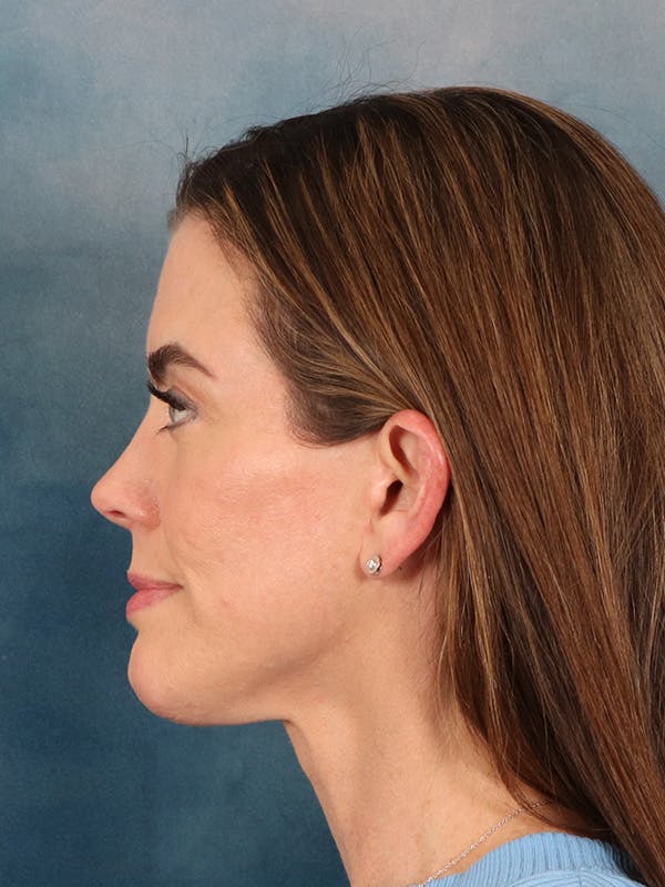 Laser Skin Resurfacing Before & After Gallery - Patient 287437 - Image 10