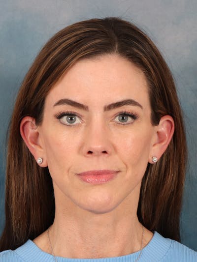 Laser Skin Resurfacing Before & After Gallery - Patient 287437 - Image 2