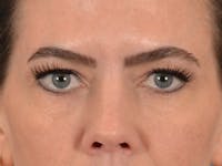 Eyelid Lift Before & After Gallery - Patient 101227 - Image 1