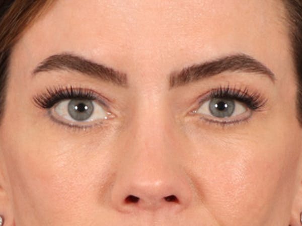 Eyelid Lift Before & After Gallery - Patient 101227 - Image 2