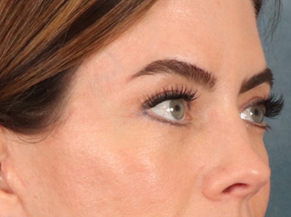 Eyelid Lift Before & After Gallery - Patient 101227 - Image 4