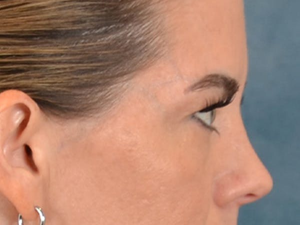 Eyelid Lift Before & After Gallery - Patient 101227 - Image 5