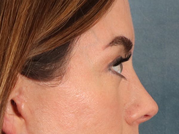 Eyelid Lift Before & After Gallery - Patient 101227 - Image 6