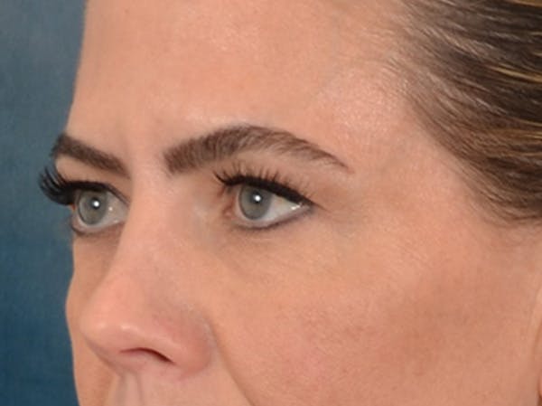 Eyelid Lift Before & After Gallery - Patient 101227 - Image 7
