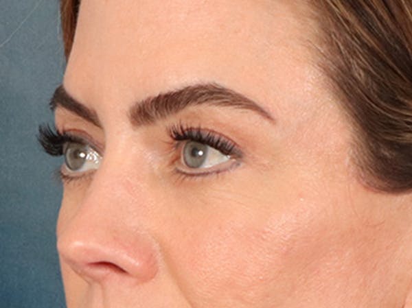 Eyelid Lift Before & After Gallery - Patient 101227 - Image 8