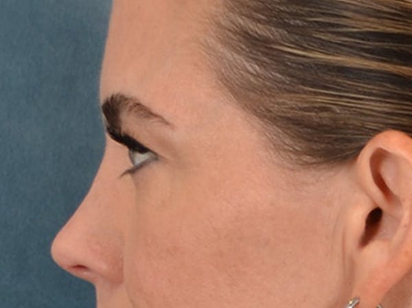 Eyelid Lift Before & After Gallery - Patient 101227 - Image 9