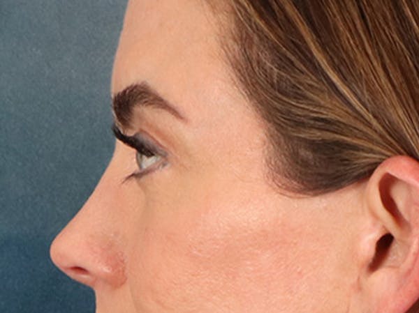 Eyelid Lift Before & After Gallery - Patient 101227 - Image 10