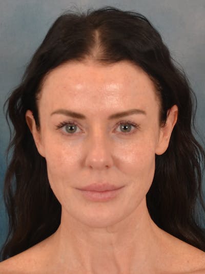 Deep Neck Lift Before & After Gallery - Patient 108140 - Image 1