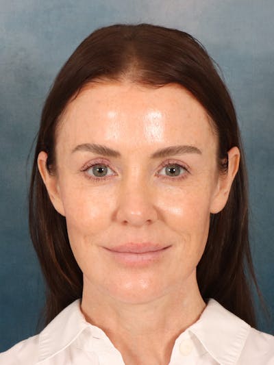 Deep Plane Facelift Before & After Gallery - Patient 275248 - Image 4